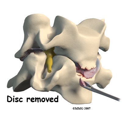 Cervical Spine Surgery Bridgewater MA  Cervical Spine Treatments Brockton  MA