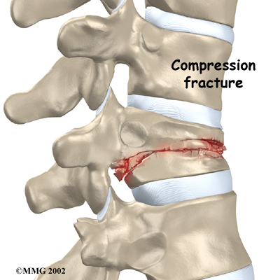 Spinal Compression Fractures Best Treatment
