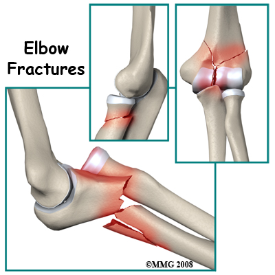 Physiotherapy in Toronto for Elbow Pain - Fractures
