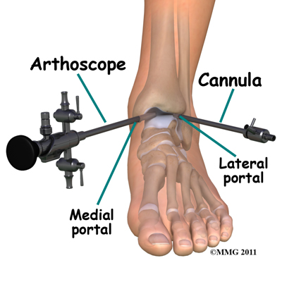 Physiotherapy in Toronto for Ankle Surgery - Arthroscopy