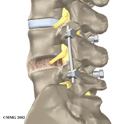 Physiotherapy in Toronto for Back - Lumbar Spinal Stenosis